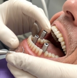 Pain Management After Same-Day Dental Implants: What You Should Know