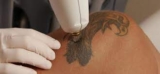 Key Insights into the PicoSure Laser Tattoo Removal Experience