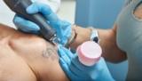 Pico Laser Tattoo Removal: The Safe Choice for Removing Unwanted Ink