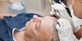 How a Hair Transplant Works to Regrow Your Hairline