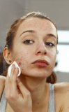 Pimples Treatment in Dubai: Budget-Friendly Tips