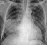 What Are Respiratory Infections?