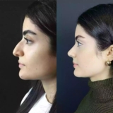 Rhinoplasty Aftercare in Dubai What to Expect Post-Surgery