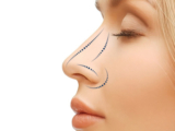 Rhinoplasty Risks and How to Avoid Complications
