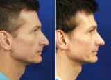 Rhinoplasty in Dubai: A Step-by-Step Journey to a New Nose