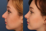 Refine Your Profile with State-of-the-Art Rhinoplasty in Riyadh