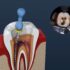 Smart Timing for Molar Removal: Health Gains Explained