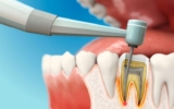 The Role of Root Canal Treatment in Cosmetic Dentistry
