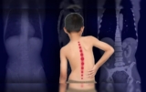 What You Need to Know About Scoliosis in Your Teen