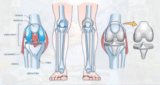 Step into a Pain-Free Life with Total Knee Replacement Surgery