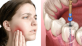 Root Canal Treatment for Sensitive Teeth How It Works