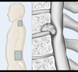 Dr. Aditya Raj: Expert Spinal Cord Tumor Treatment in Mumbai