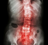 Best Spondylitis Treatment in Mumbai by At Synapse Spine