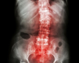 What Is the Best Spondylitis Treatment in Mumbai?