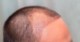 Step-by-Step FUT Hair Transplant Procedure
