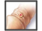 Syphilis Treatment In India – Best Sexologists in Navi-mumbai
