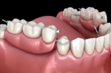 Teeth Dentures for the Modern Age: Innovations You Should Know About