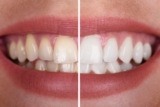 Unlock a Radiant Smile with Expert Teeth Whitening Tips