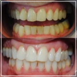 Dental Crown in Mitcham for Healing Broken Teeth