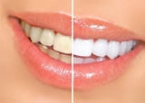 From Whitening to Veneers: Key Advantages of Smile Enhancement