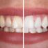Best Cosmetic Dental Treatments for Gaps and Misaligned Teeth