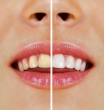 Affordable Teeth Whitening