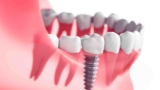 The History of Dental Implants You Need to Know