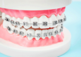 The Science Behind Metal Braces: How They Straighten Your Teeth