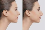 The Surge in Popularity of Rhinoplasty in Dubai Why It’s So Sought After