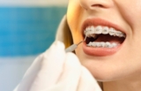 The Top Benefits of Getting Dental Braces as an Adult