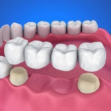 How Full-Tooth Overlays Protect Your Natural Enamel?