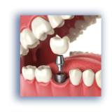 Vijaya Dental Care : Top Tooth Implant Clinic in Kolathur, Chennai