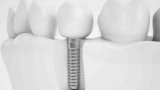 Top Dental Implants in Dubai – Trusted Quality & Care