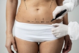 Liposuction Surgery in Gurgaon