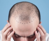 Revive & Restore: Your Destination for Expert Hair Transplants Clinic in Kolkata!