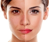 What Are the Most Common Causes of Melasma in Dubai’s Climate
