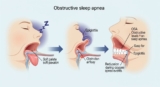 What Happens if Obstructive Sleep Apnea Is Untreated
