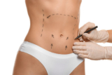 The Science Behind Tummy Tuck: How It Works