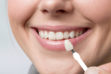 What Makes Non-Prep Veneers Different from Traditional Veneers?