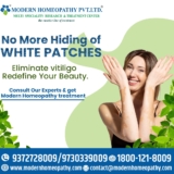 best Homeopathy Treatment for Vitiligo