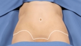 Will I Have Visible Scars After My Tummy Tuck in Dubai