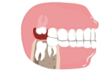 Wisdom Teeth Extraction to Deal with Dental Problems