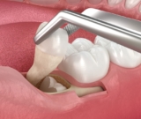 4 Signs You Should Not Ignore When You Need Wisdom Tooth Extraction in Whyalla!