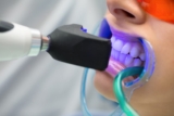 Zoom Teeth Whitening: A Step Toward a Perfect Smile in Just One Hour