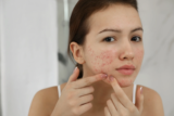 Combining Treatments for Effective Acne Scar Removal in Islamabad