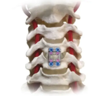 CDF Surgery in Mumbai: Expert Care at Synapse Spine