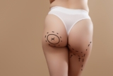 Frequently Asked Questions About Buttock Augmentation in Dubai