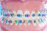 Orthodontics: Achieving a Perfectly Aligned Smile