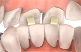 Why are Bite Turbos Used in Orthodontic Treatment?