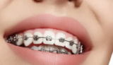 5 Common Misconceptions About Braces Treatment